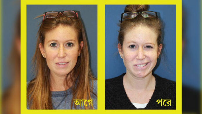 Bell's palsy Disorder